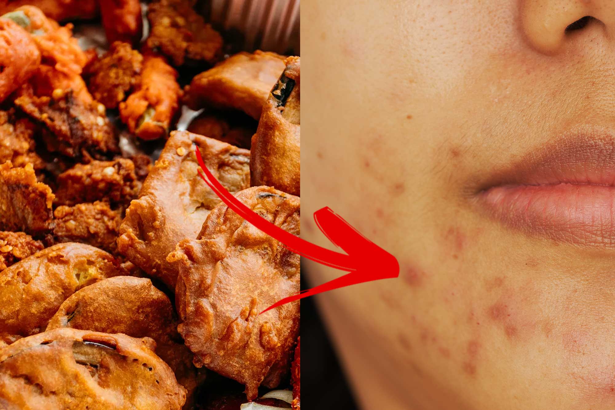 Foods That Can Cause Acne